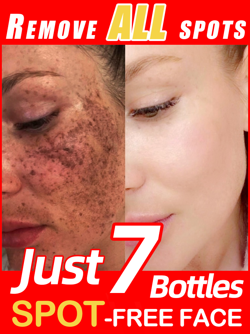 Lighten Freckles Melasma, Faci - Luxury Natural Skincare ulasan dan harga